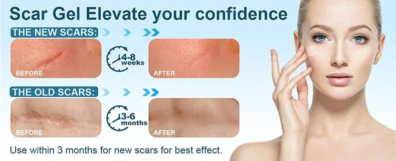 Fast Scar Removal Cream Treatment Stretch Marks Burn Surgical Scar Acne Spots Repair Gel Whitening Moisturizing Smooth Skin Care