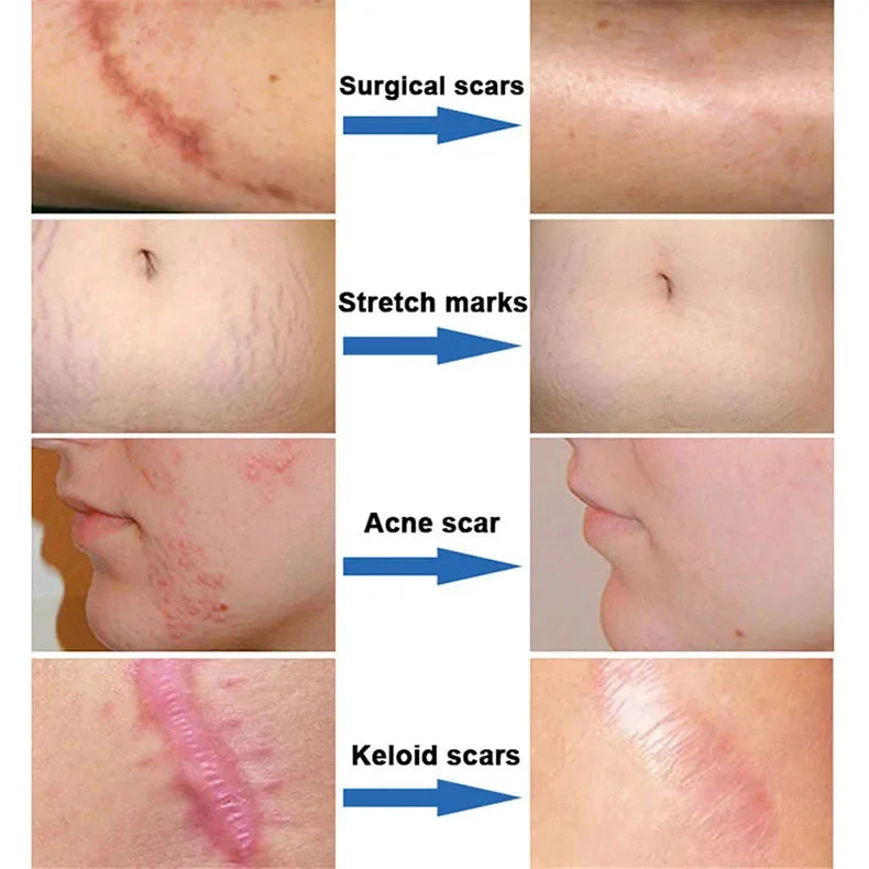 Fast Scar Removal Cream Treatment Stretch Marks Burn Surgical Scar Acne Spots Repair Gel Whitening Moisturizing Smooth Skin Care