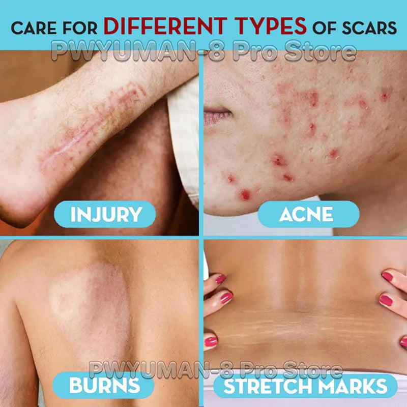 Fast Scar Removal Cream Treatment Stretch Marks Burn Surgical Scar Acne Spots Repair Gel Whitening Moisturizing Smooth Skin Care