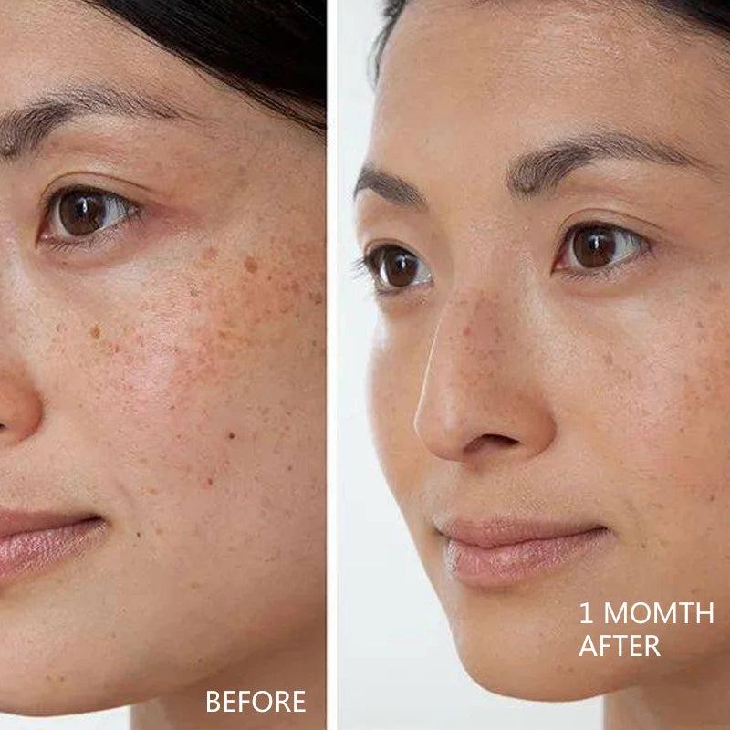 Dark Spots Remove Kojic Acid Cream Face Nicotinamide Effective Whiten Anti-pigmentation Improve Dullness Skin Care Cream 50ML