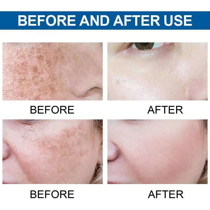 Kojic Acid Fades Freckle Dark Spot Face Serum with Niacinamide and Vitamin E for Quick Brightening Nourishing Skin Care Product