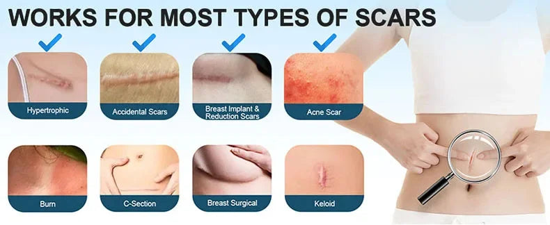 Fast Scar Removal Cream Treatment Stretch Marks Burn Surgical Scar Acne Spots Repair Gel Whitening Moisturizing Smooth Skin Care
