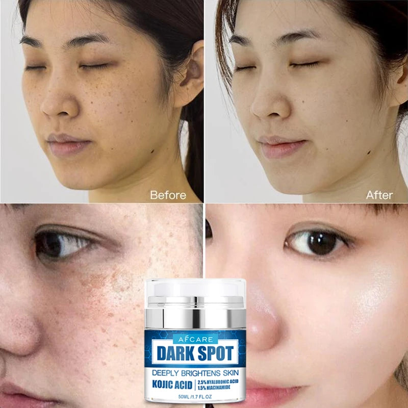Dark Spots Remove Kojic Acid Cream Face Nicotinamide Effective Whiten Anti-pigmentation Improve Dullness Skin Care Cream 50ML