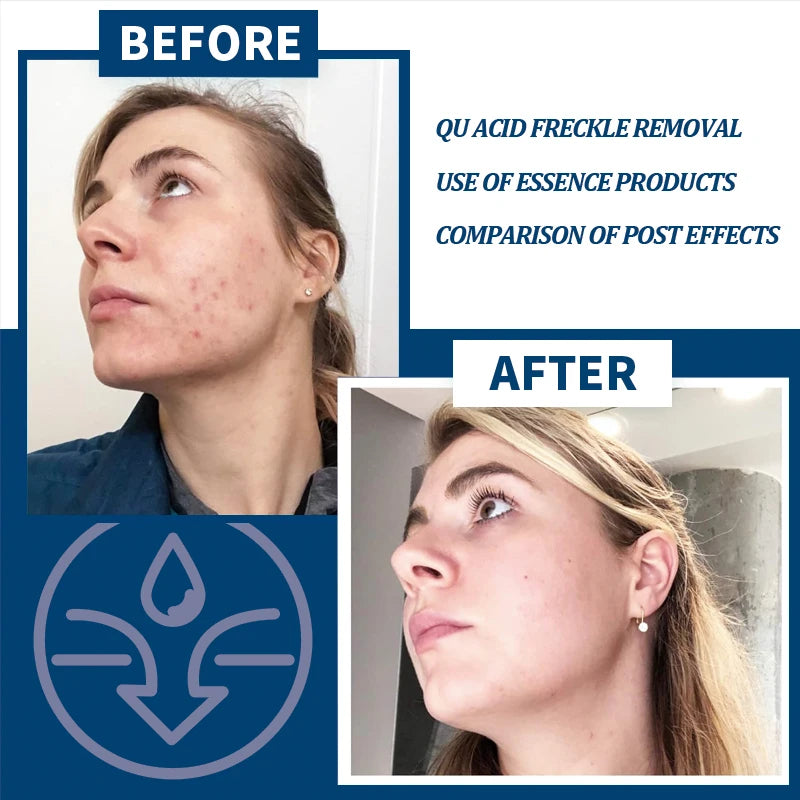 Kojic Acid Fades Freckle Dark Spot Face Serum with Niacinamide and Vitamin E for Quick Brightening Nourishing Skin Care Product