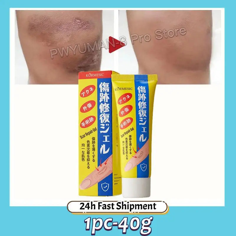 Fast Scar Removal Cream Treatment Stretch Marks Burn Surgical Scar Acne Spots Repair Gel Whitening Moisturizing Smooth Skin Care
